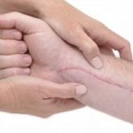 Did You Know Can Physical Therapy Help Scars?