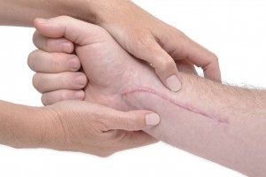Did You Know Can Physical Therapy Help Scars?